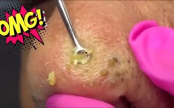 Blackhead Removal from Nose