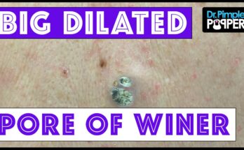 Two HUGE Dilated Pores of Winer!! 😱